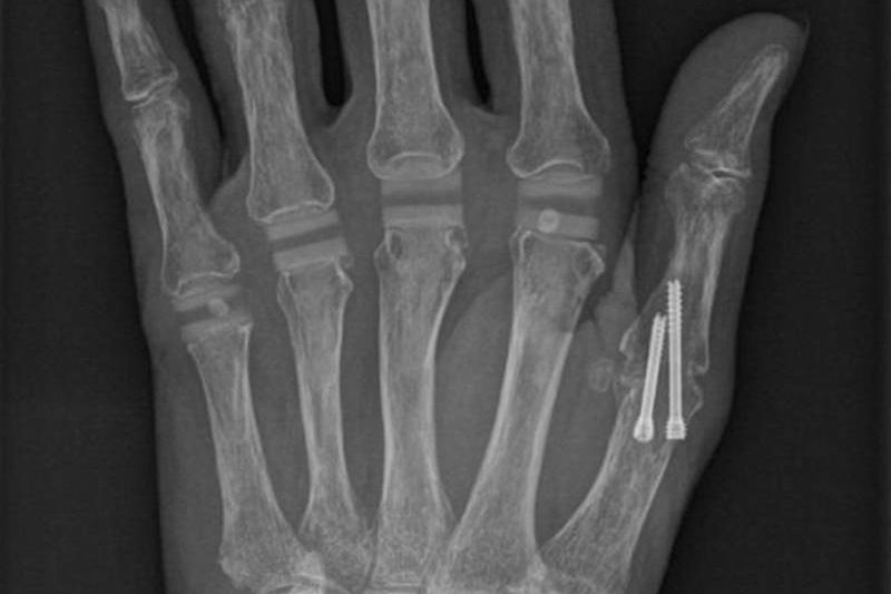 X-ray of a hand affected by arthritis