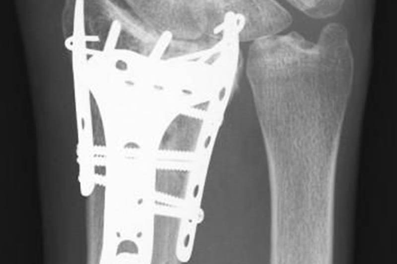 X-ray of a surgically repaired wrist fracture
