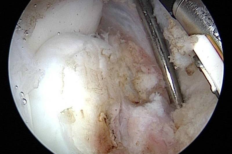 Arthroscopic view during keyhole surgery