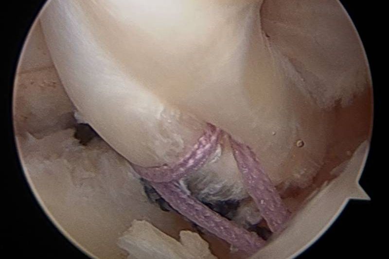 Arthroscopic view of a tendon repair